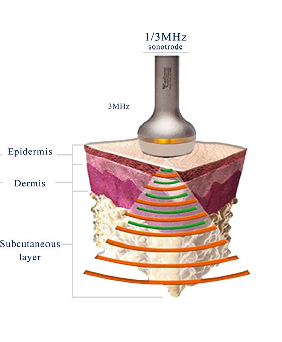 depth of penetration 1